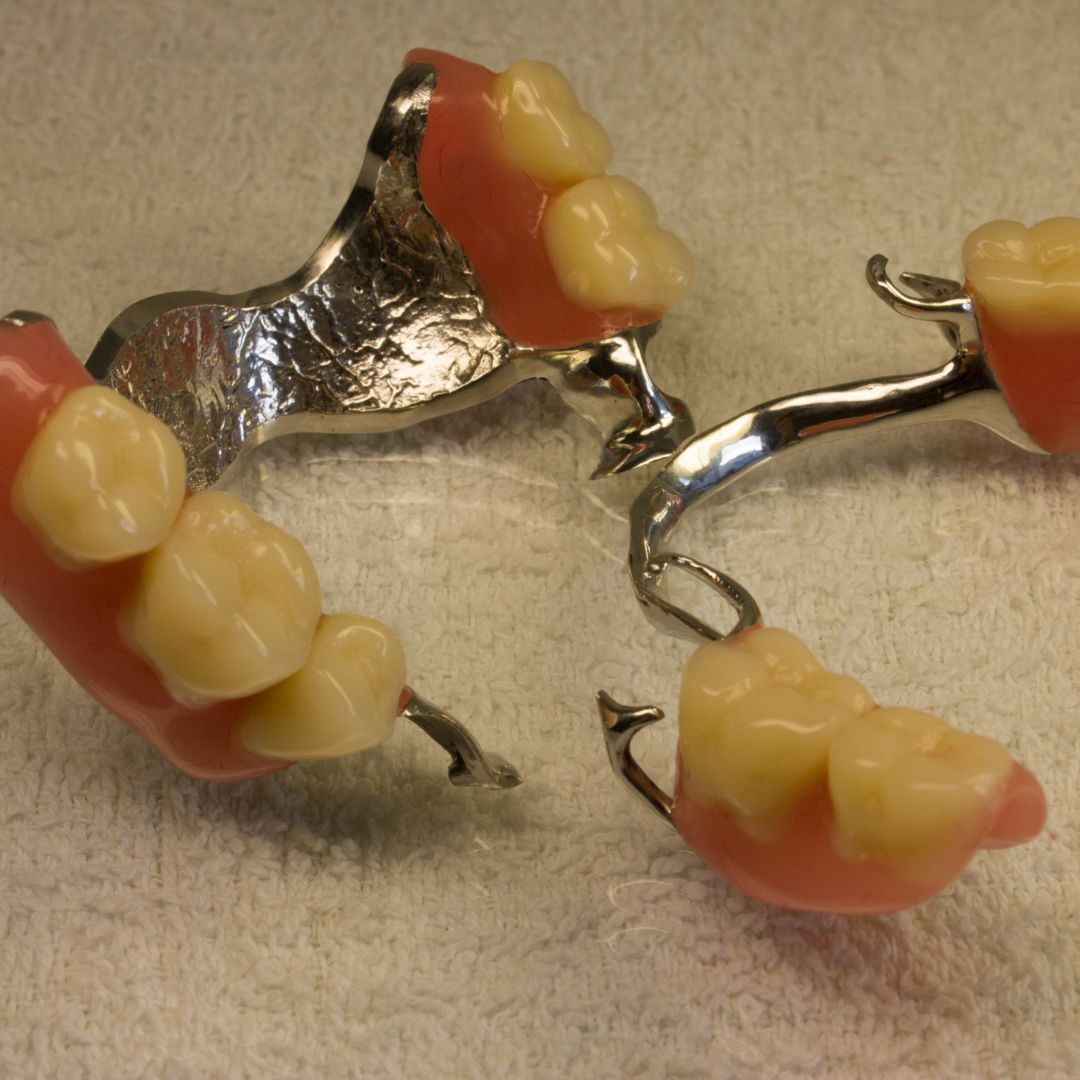 tooth extraction (16)