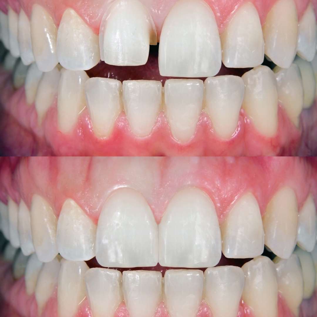 tooth extraction (18)