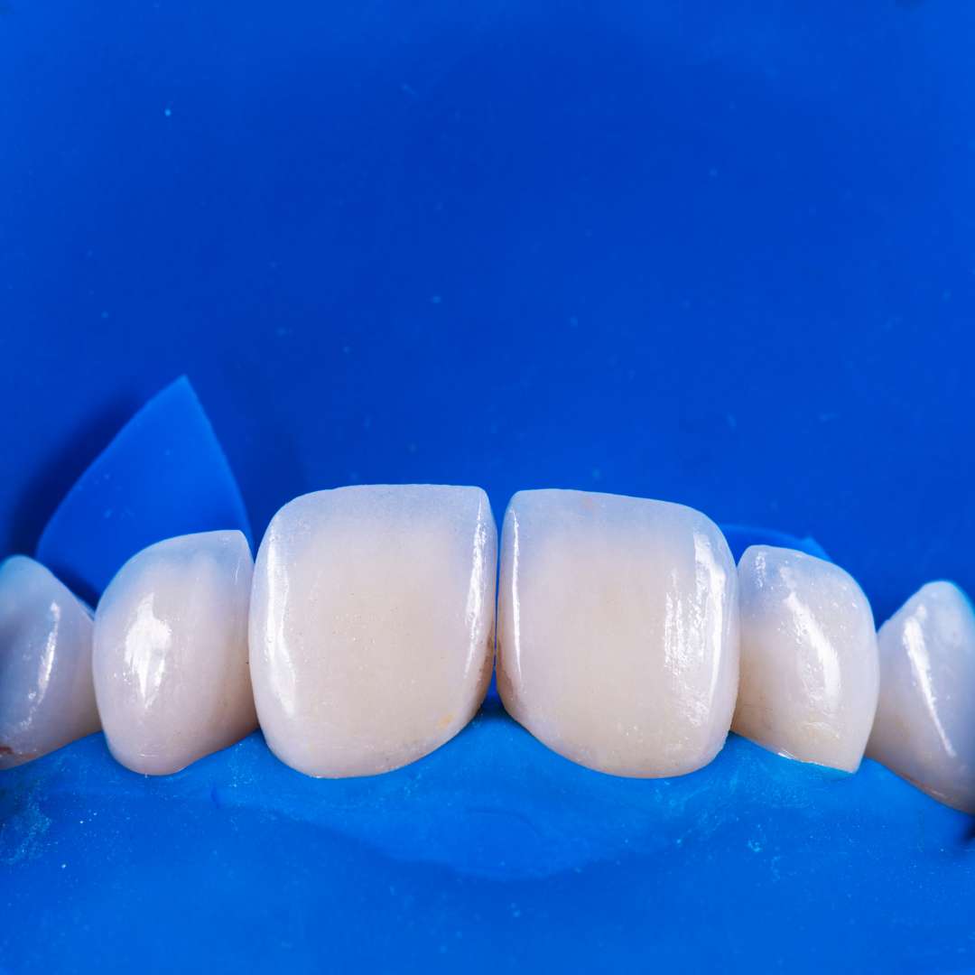 tooth extraction (20)