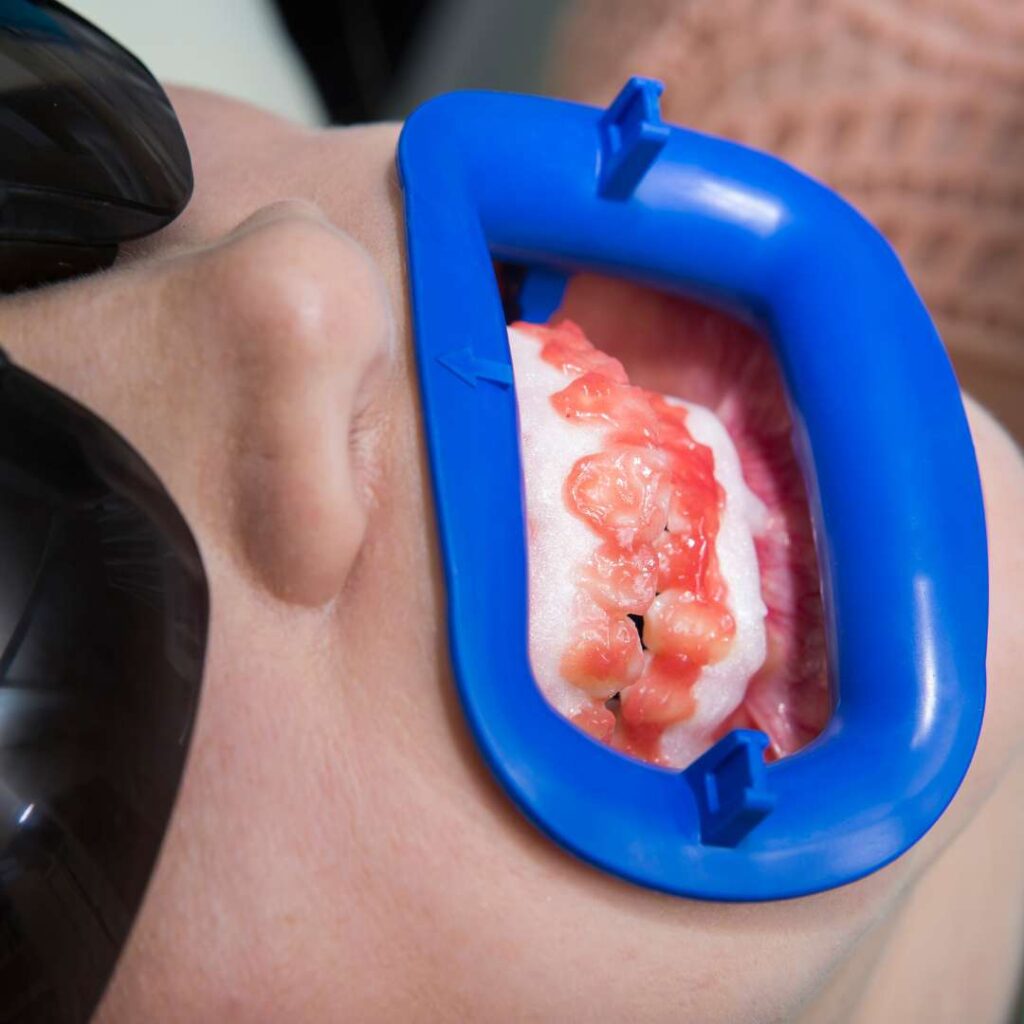 tooth extraction (23)
