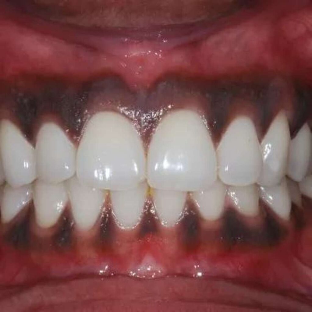 tooth extraction (28)