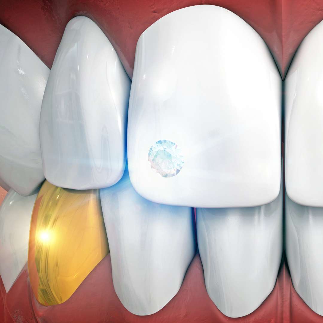 tooth extraction (31)