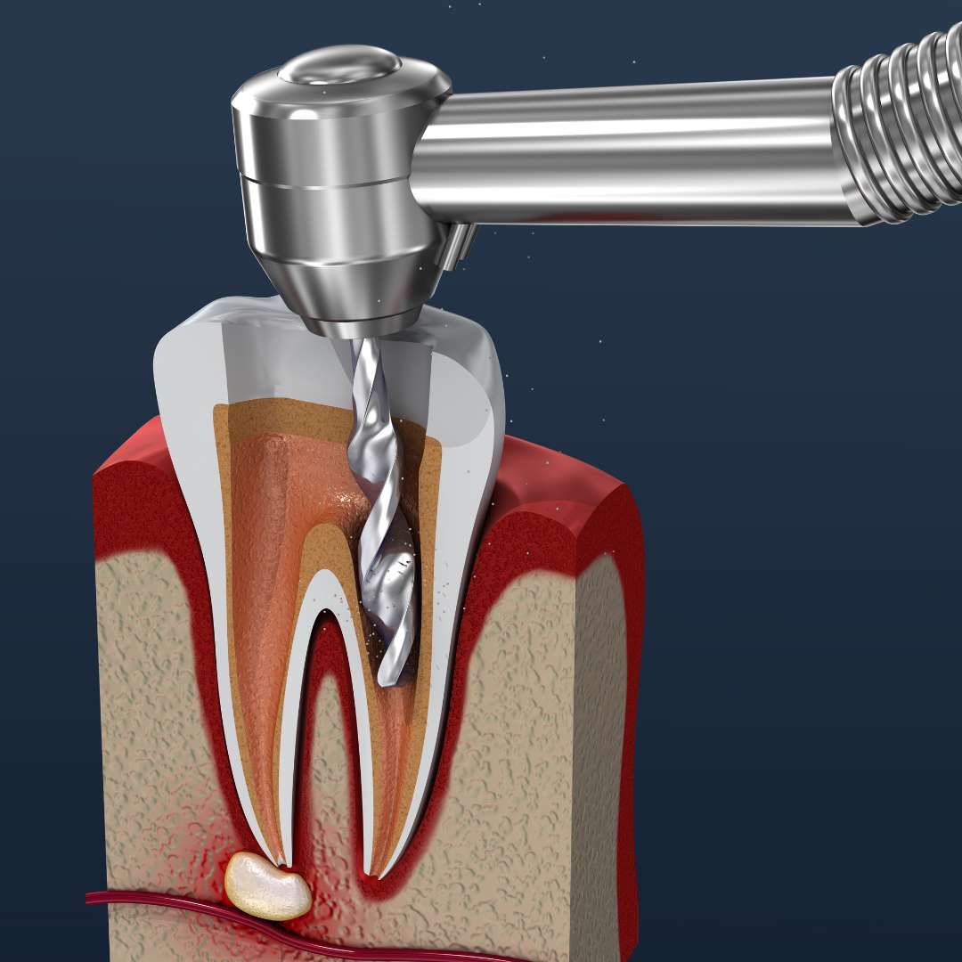 tooth extraction (34)