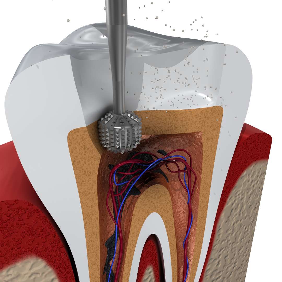 tooth extraction (35)