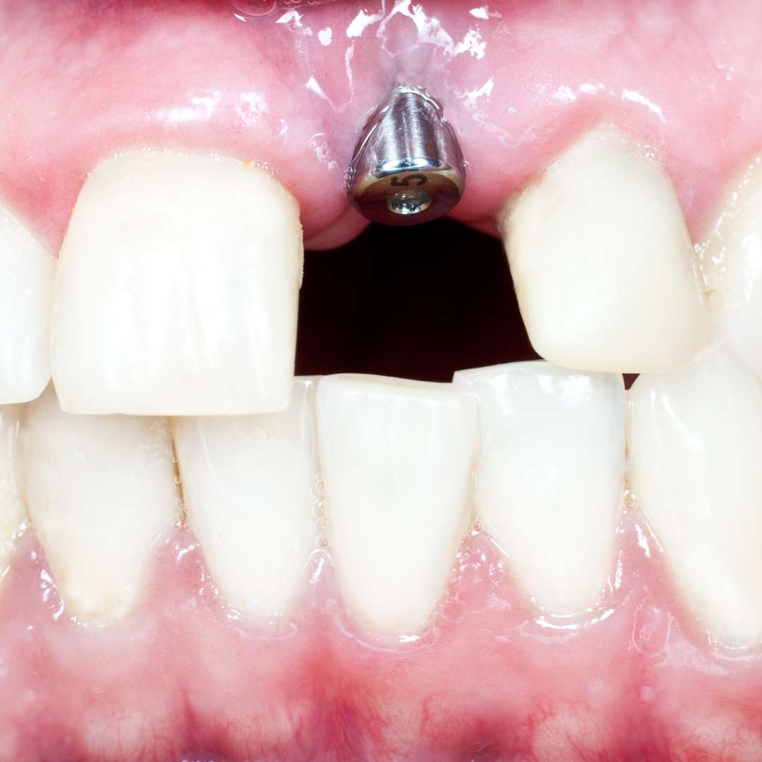 tooth extraction (43)