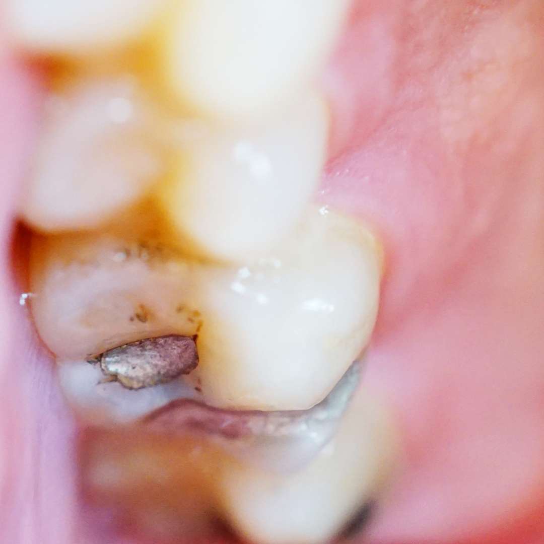 tooth extraction (46)