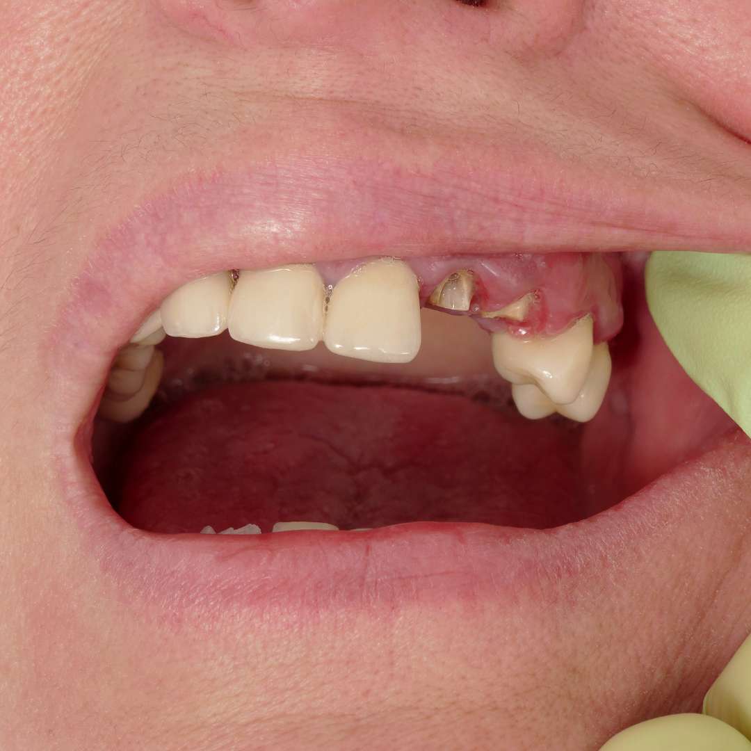 tooth extraction (59)