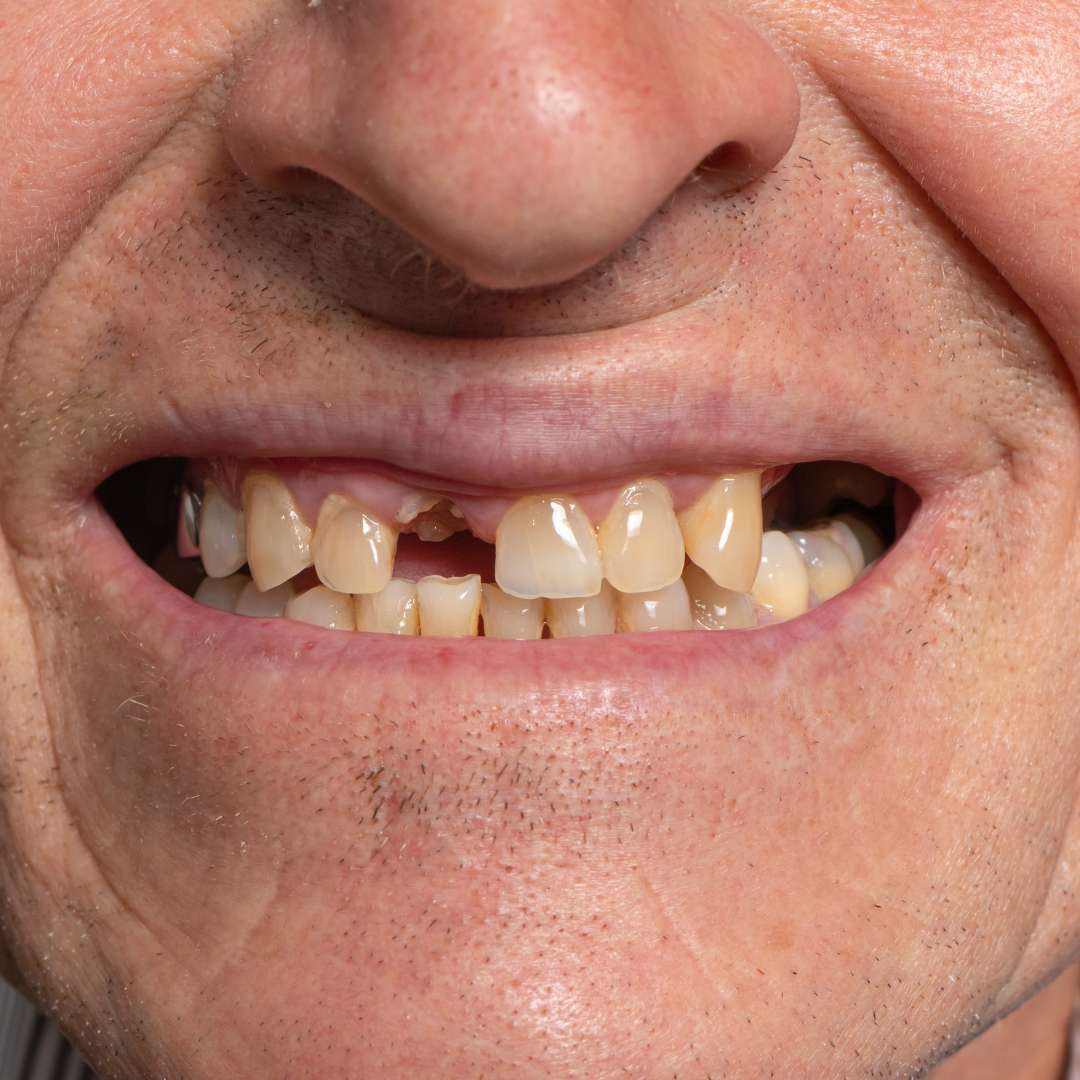 tooth extraction (60)