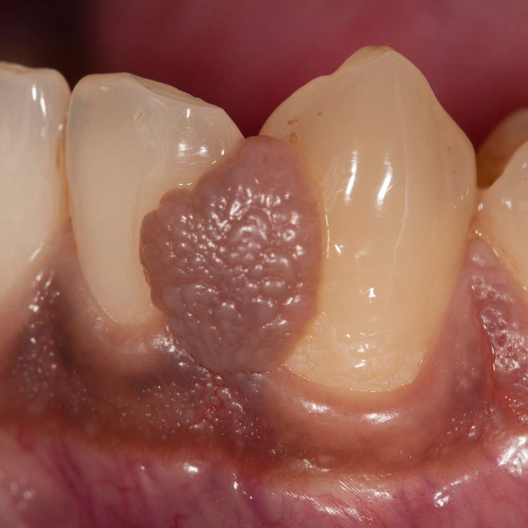 tooth extraction (8)